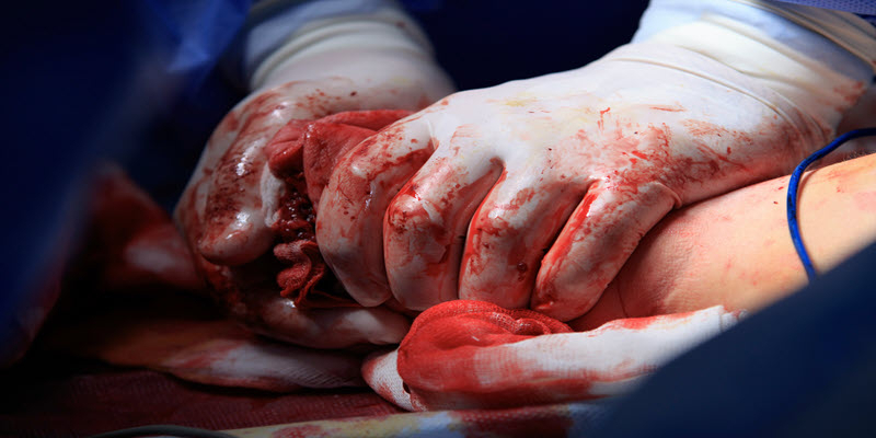 A surgeon wearing gloves performs a procedure, holding tissue and organs during surgery with visible blood and medical tools.