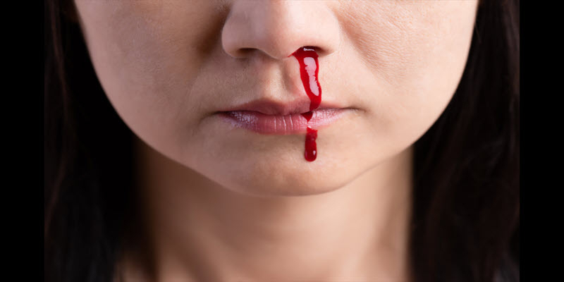 A person with a nosebleed; blood is visibly streaming from one nostril down to the upper lip.