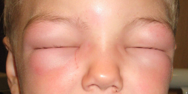 Close-up of a child's face with both eyes swollen shut due to significant periorbital edema.