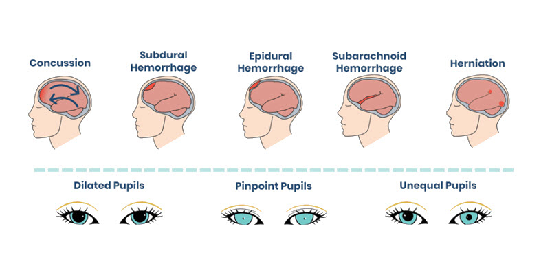 Diagram showing five brain injuries (concussion, subdural hemorrhage, epidural hemorrhage, subarachnoid hemorrhage, herniation) with corresponding pupil changes: dilated, pinpoint, or unequal.