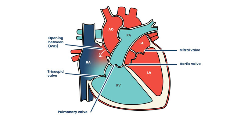 Diagram of the human heart showing labeled chambers, valves, and an opening between the right and left atria, noted as atrial septal defect (ASD).