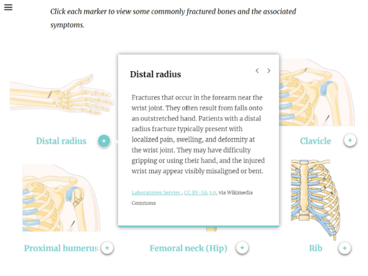 A webpage shows an interactive diagram of common bone fracture sites, with a pop-up describing distal radius fractures near the wrist and highlighting the forearm bone.